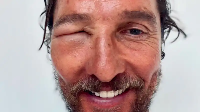 Matthew McConaughey, photo of swollen eye from bee sting.